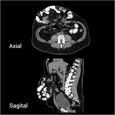 Case Report: Intraoperative Fascial Traction for Increasing Intra-Abdominal Volume in Loss-of-Domain Incisional Hernias: A Report of Two Cases